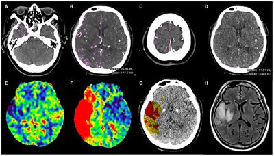 Preliminary Application of a Quantitative Collateral Assessment Method in Acute Ischemic Stroke Patients With Endovascular Treatments: A Single-Center Study
